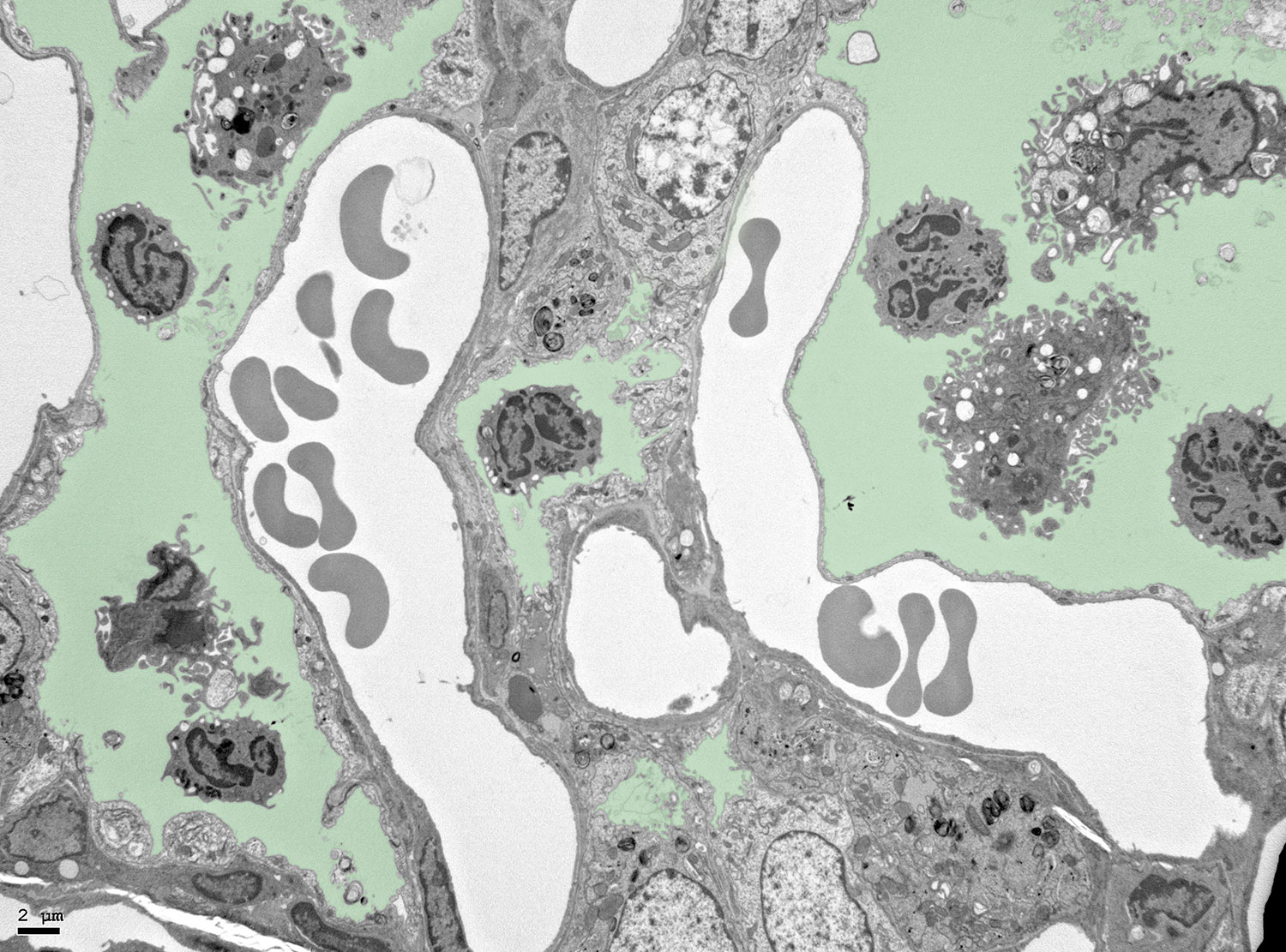 Electron microscopy imaging of the lung at day 5 after induction of HDM airway allergy, showing hypertrophic pneumocytes and leukocytes in the alveolar space, coloured in light green (Feo-Lucas et al., Frontiers in Immunology 2023).