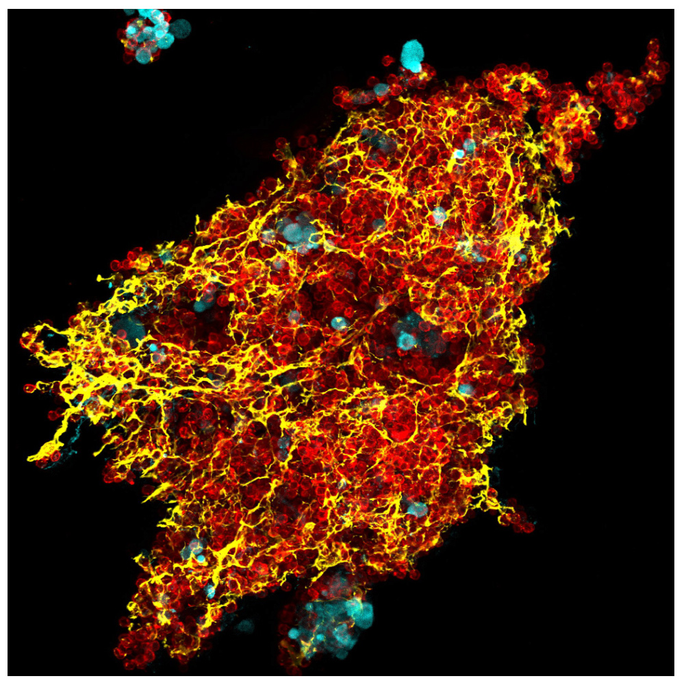 Imaging of the peritoneal wall by whole mount immunofluorescence combined with confocal microscopy, showing an LPM-tumor cell aggregate harboring a developed fibrin nerwork, at 4 hours after intraperitoneal injection of mouse tumor organoids derived from colorectal tumors. Blue: tumor cells; red: F4/80, peritoneal macrophages; yellow: fibrinogen.