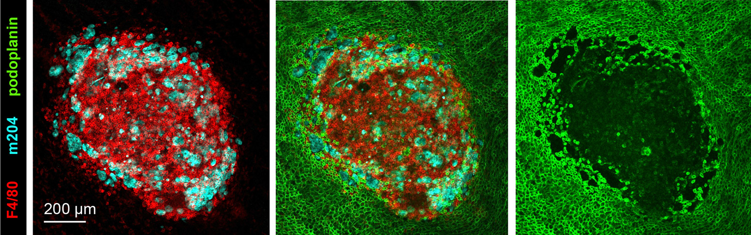 LPM-tumor cell aggregate in the peritoneal wall, at 4 hours after intraperitoneal injection of mouse tumor organoids, showing the profound disorganization of the mesothelieum underneath the aggregate. Blue: tumor cells; red:  F4/80, peritoneal macrophages; green: podoplanin, mesothelial cells.