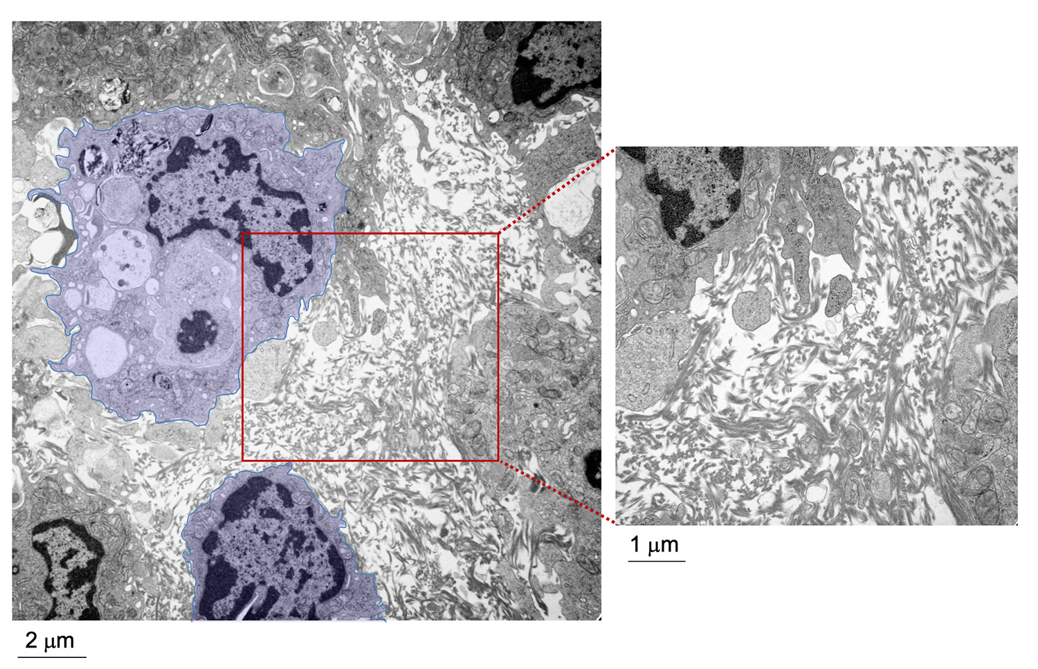 Electron microscopy imaging of an LPM-tumor cell aggregate at 20 minutes after intraperitoneal injection of mouse tumor organoids, showing the fibrin network between peritoneal macrophages (coloured in violet); right panel: enlargement of the area marked in the left panel.
