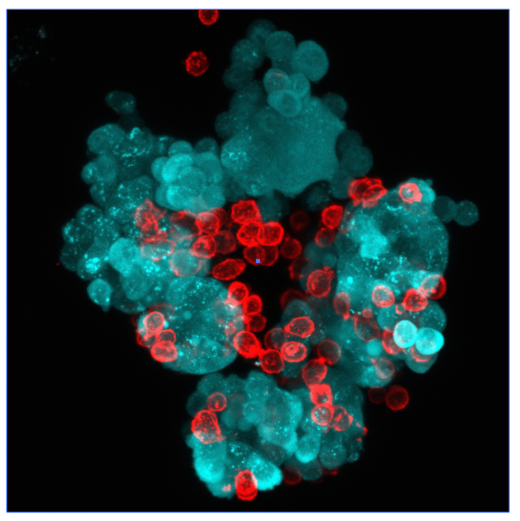 LPM-tumor cell aggregate free in the peritonal cavity, at 5 minutes after intraperitoneal injection of mouse tumor organoids. Blue: tumor cells; red:  F4/80, peritoneal macrophages.