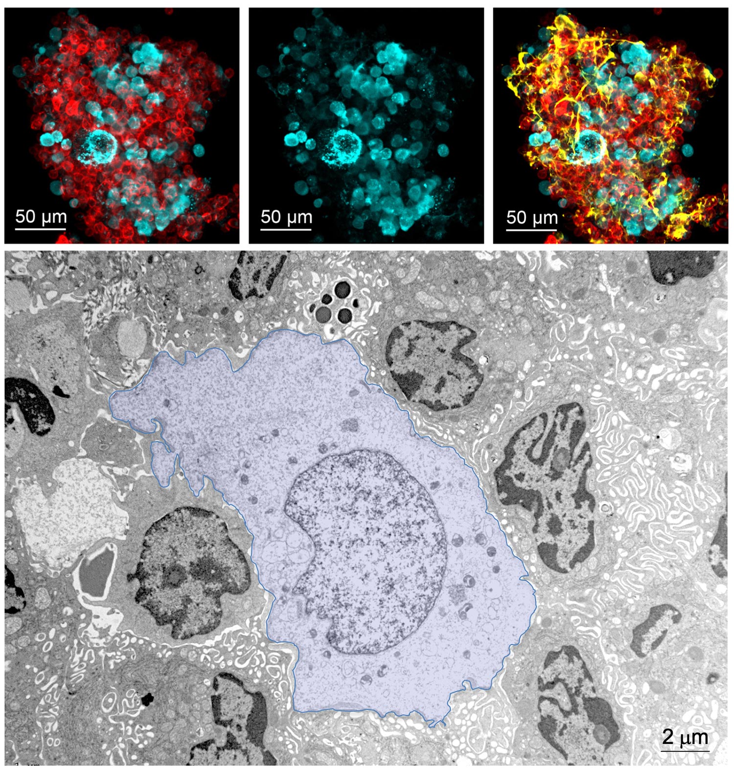 LPM-tumor cell aggregate free in the peritonal cavity, at 30 minutes after intraperitoneal injection of mouse tumor organoids. Blue: tumor cells; red:  F4/80, peritoneal macrophages; yellow: fibrinogen. Lower panel: electron microscopy image of an LPM-tumor cell aggregate free in the peritonal cavity, at 20 minutes after intraperitoneal injection of mouse tumor organoids, showing a necrotic tumor cell (coloured in violet), surrounded by peritoneal macrophages.